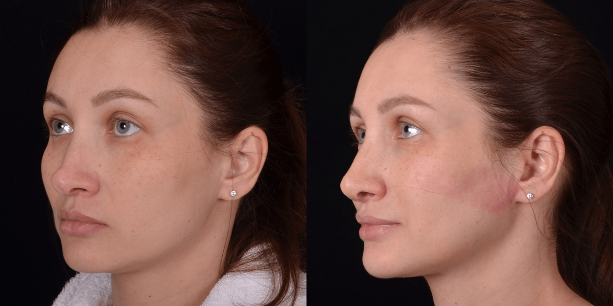 Ринопластика концевого отдела носа. Фото до и после. Фото с сайта Д.Р. Гришкяна. Имеются противопоказания, требуется консультация специалиста