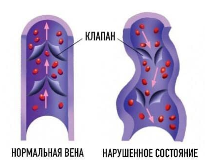 Формирование варикозного расширения вен. Нормально функционирующая вена без патологии венозных клапанов (А). Варикозное расширение вен с деформированным клапаном, нарушением притока крови, и растянутыми стенками вен (B).