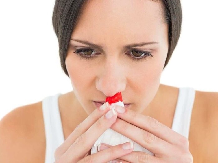 Фото Кровотечение из носа. 