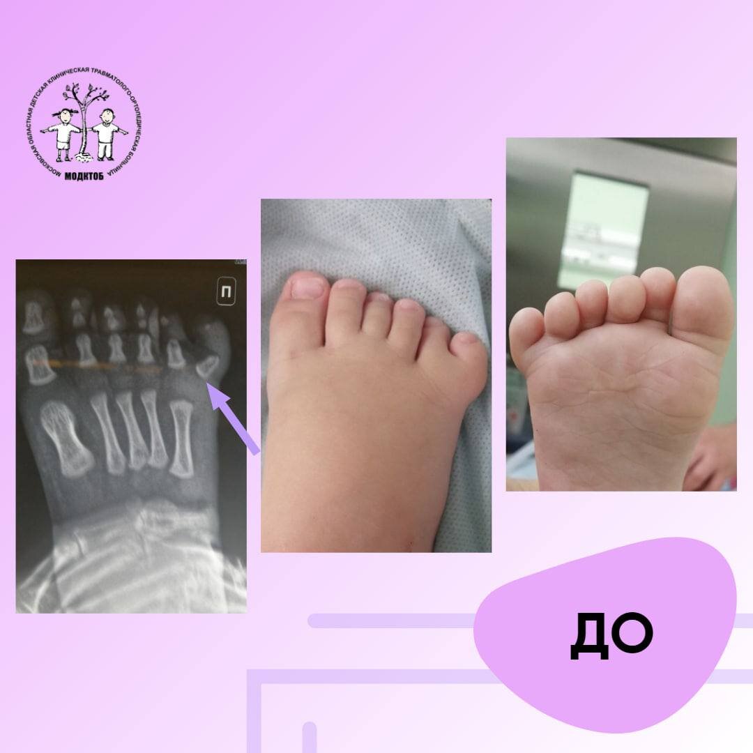 Стопа ребёнка до лечения