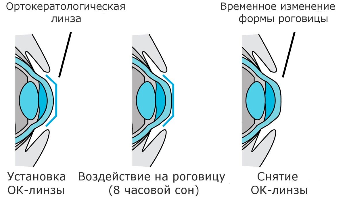 Офтальмолог рассказала, какие бывают контактные линзы, из чего их делают и  когда их не стоит носить | Минобрнауки России | Дзен