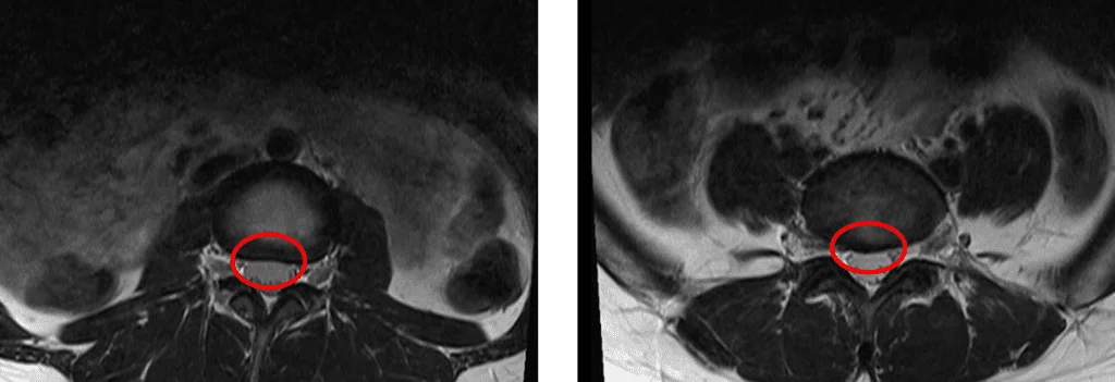 Аксиальная Т2-взвешенная МРТ поясничного отдела позвоночника