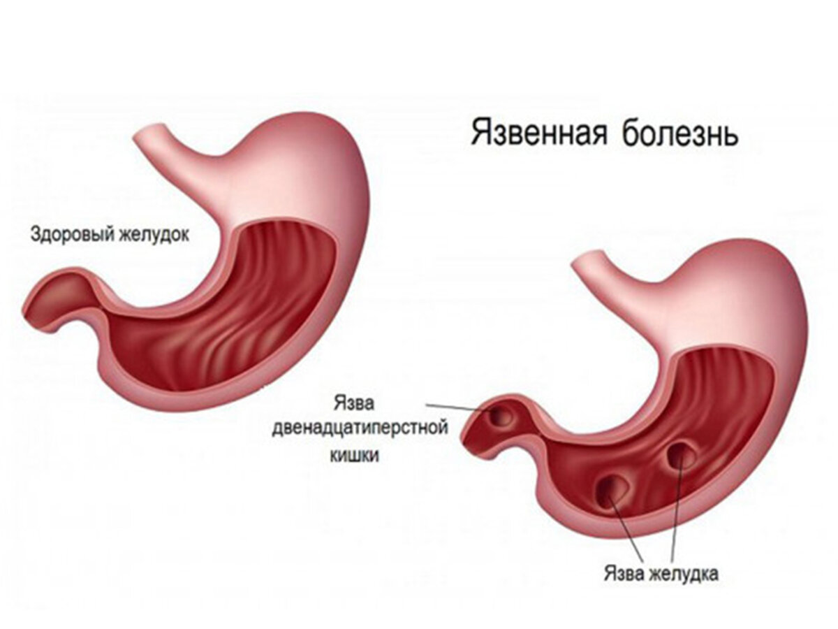 Язвенная болезнь желудка и 12 перстной кишки картинки