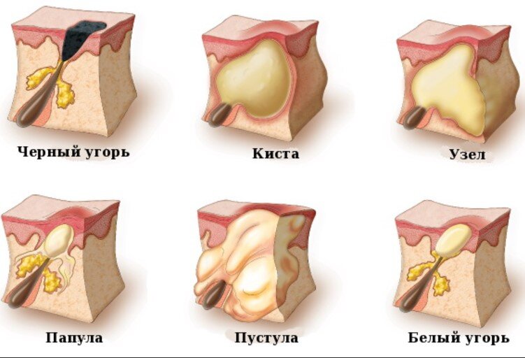 Виды прыщей и их лечение — ПРОПЕЛЛЕР