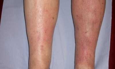 Причины себорейного дерматита у взрослых
