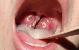 Симптомам ангины Комаровский уделяет особое внимание, так как важно не перепутать признаки с другими болезнями. У детей симптомы проявляются очень быстро и агрессивно. По этой причине ангину очень часто путают с гриппом. Стоит прислушаться к Комаровскому об ангине у детей, чтобы научиться распознавать признаки. Проявление таких признаков помогут родителям: