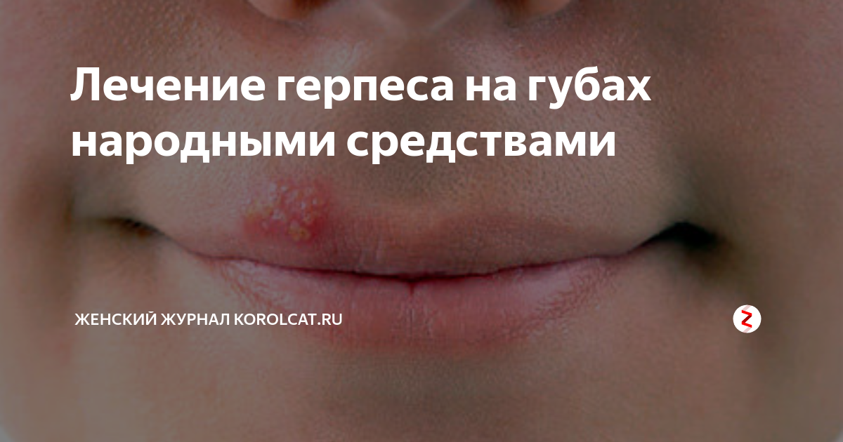 11 самых эффективных народных методов лечения герпеса