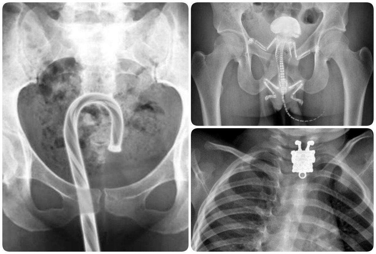 Вещи в теле. Инородные тела в прямой кишке рентген. Рентгенологические находки в прямой кишке. Инородное тело в кишечнике рентген. Инородные предметы на рентгене.