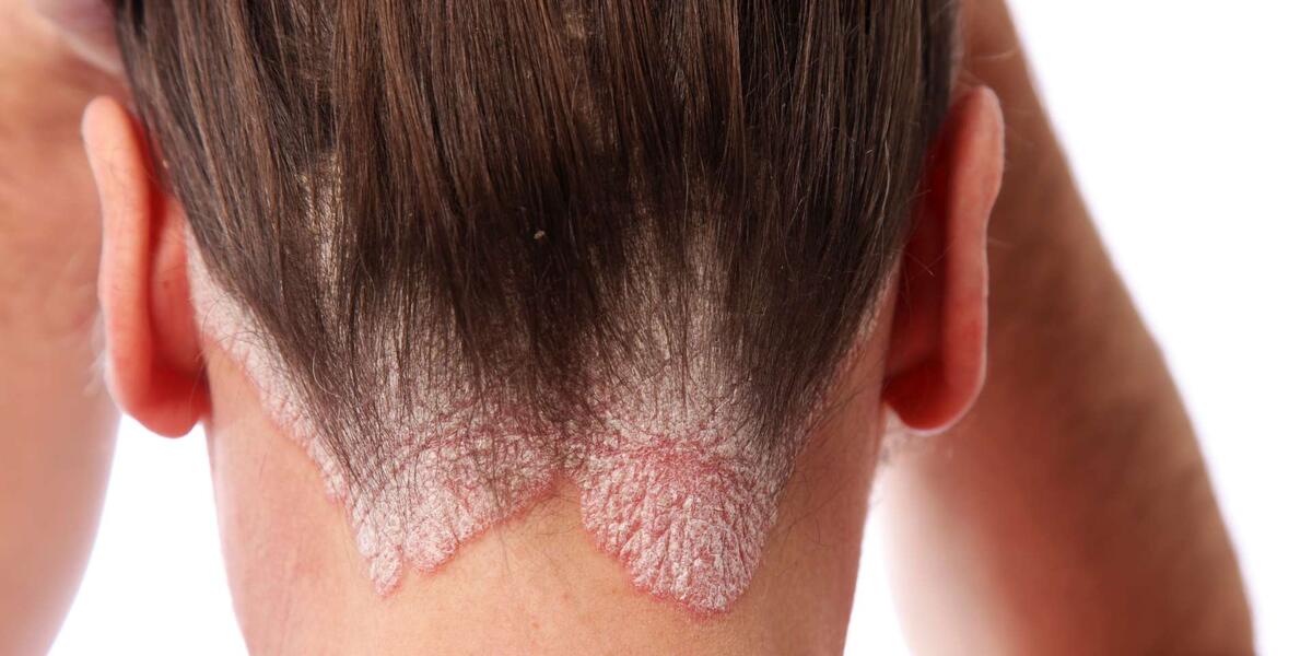 Аллергия на краску