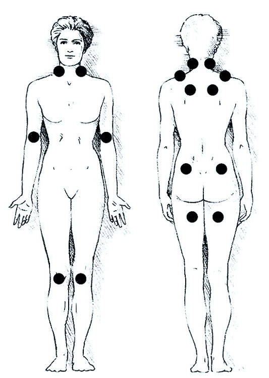 Точки (триггеры) боли при фибромиалгии.