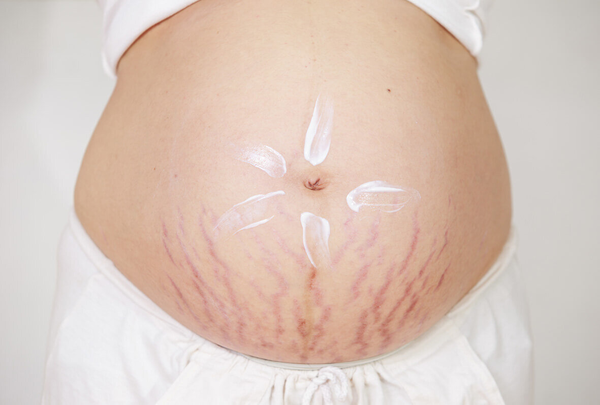 растяжки на груди во время беременности фото фото 18