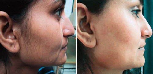 Фотография до и после применения крема с сайта производителя Эфлоры