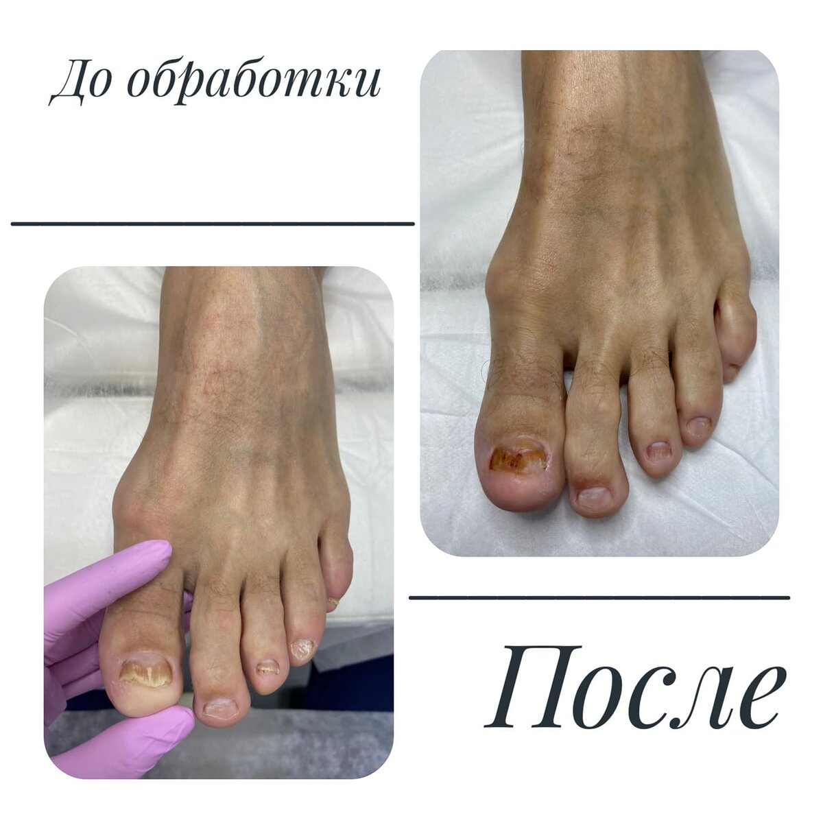 Ребята микоз на ранней стадии очень легко лечиться, проверено. Просто нужна система и регулярное посещение вашего подолога. 