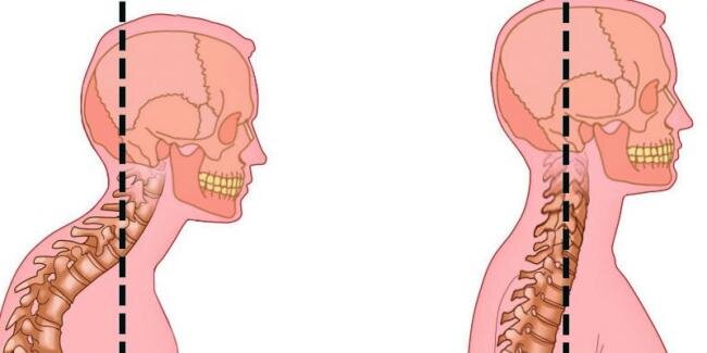 Смещение головы вперед. Источник: Яндекс. Картинки 