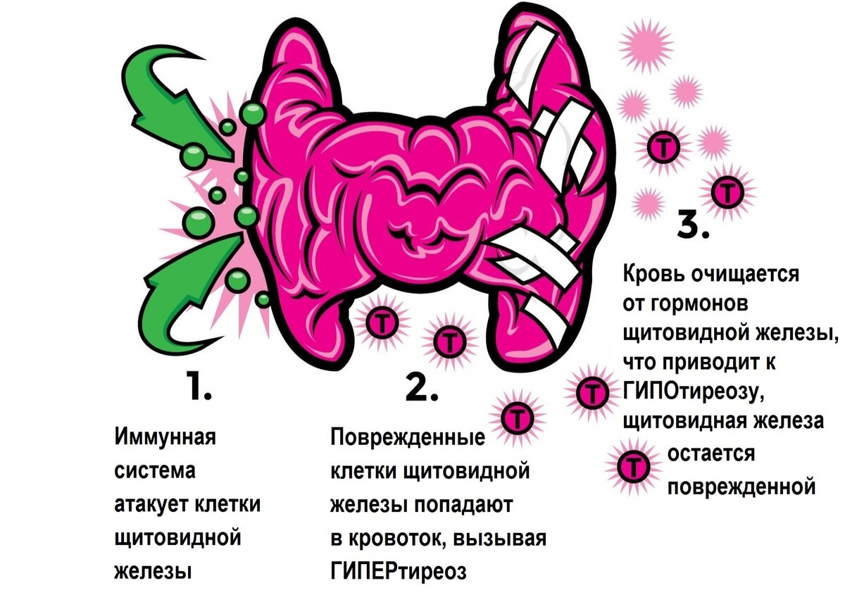 Аутоиммунный тиреоидит клиническая картина