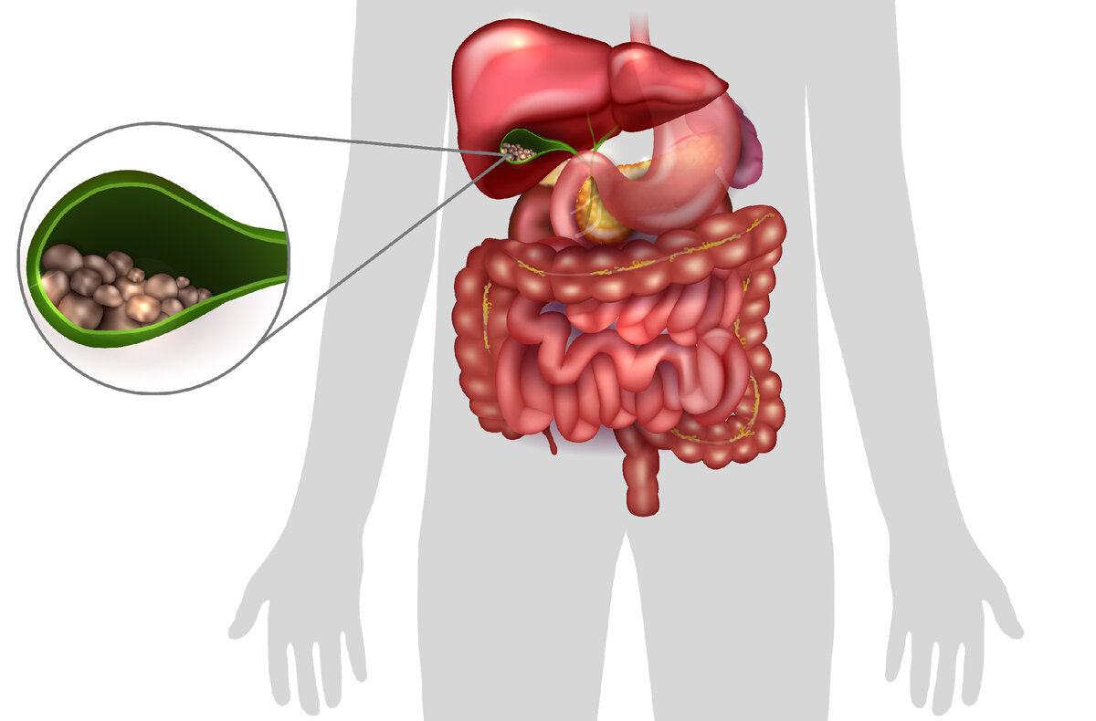 Камни в желчном: лечение желчнокаменной болезни (ЖКБ)