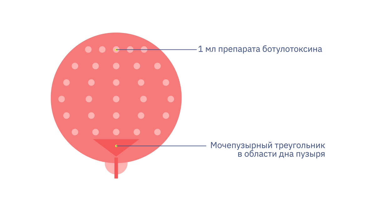 Послушная струя мочи с помощью ботокса — это как? | Купрум | Дзен