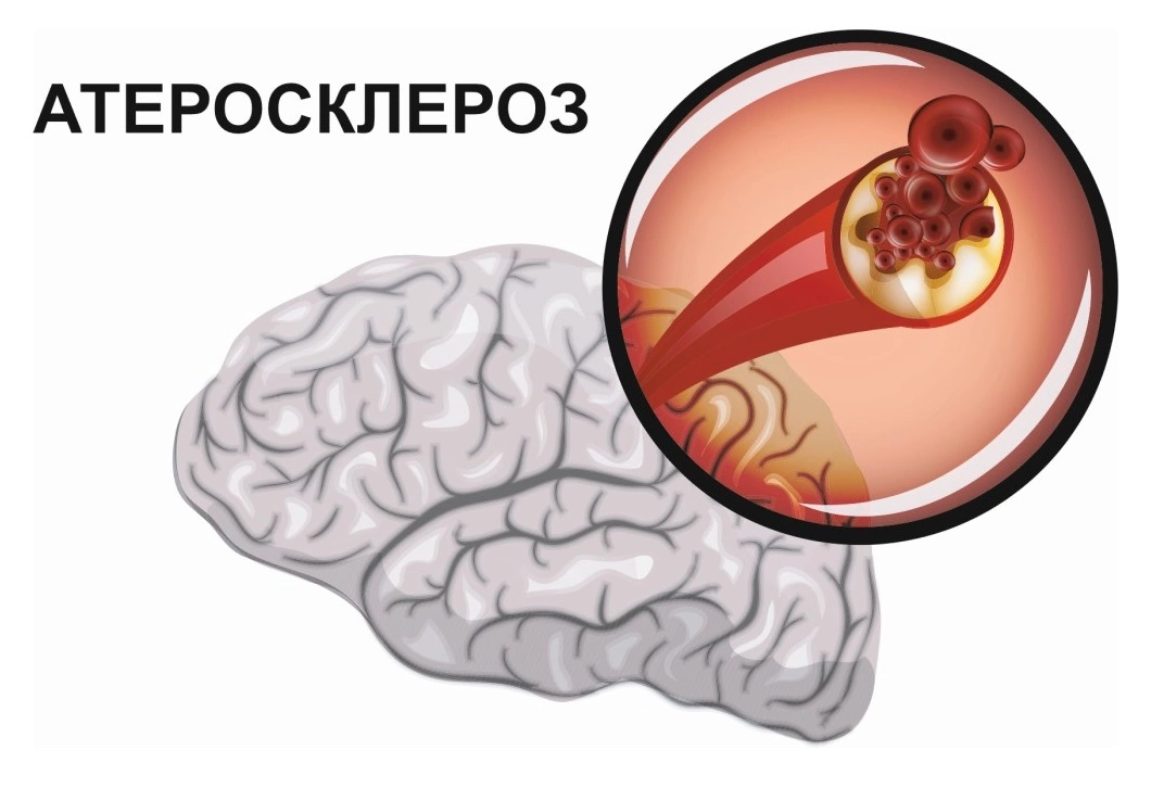 Головного мозга атеросклероз народное средство. Атеросклероз головного мозга. Атеросклероз сосудов головного МОЗ. Атеросклероз сосудов головного мозга симптомы.