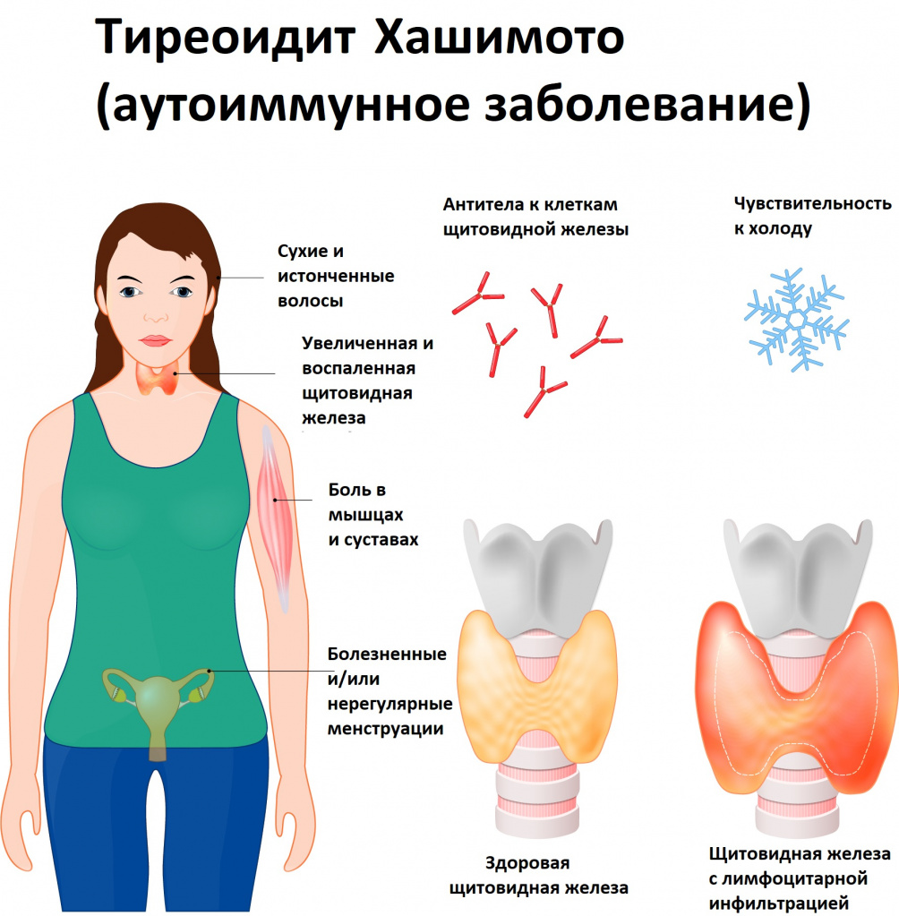 Марихуана и щитовидная железа выращивание конопля домашних