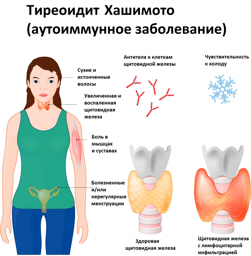 Аит щитовидной железы что это. Щитовидная железа болезнь Хашимото. Аутоиммунный тиреоидит гипотиреоз. Аутоиммунное поражение заболевание щитовидной железы-. Хронический иммунный тиреоидит причины.