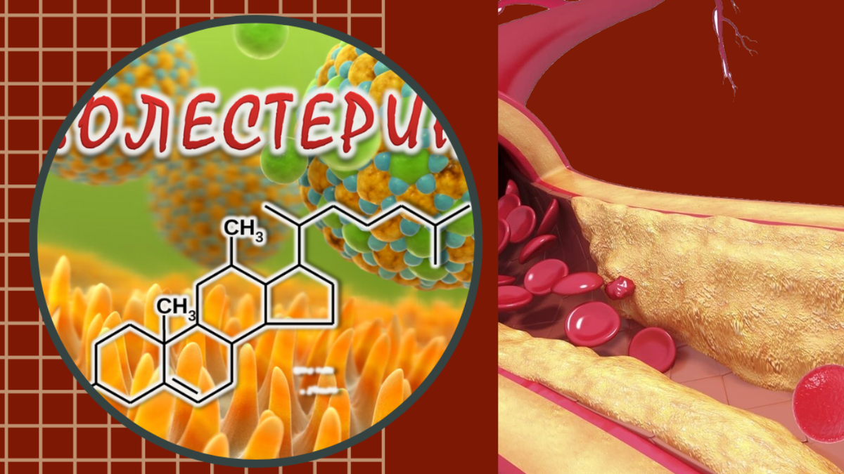 Как снизить уровень своего холестерина | Надежда для сердца | Дзен