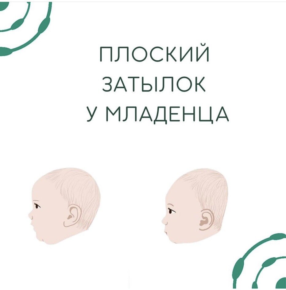 плоский затылок у младенцев
