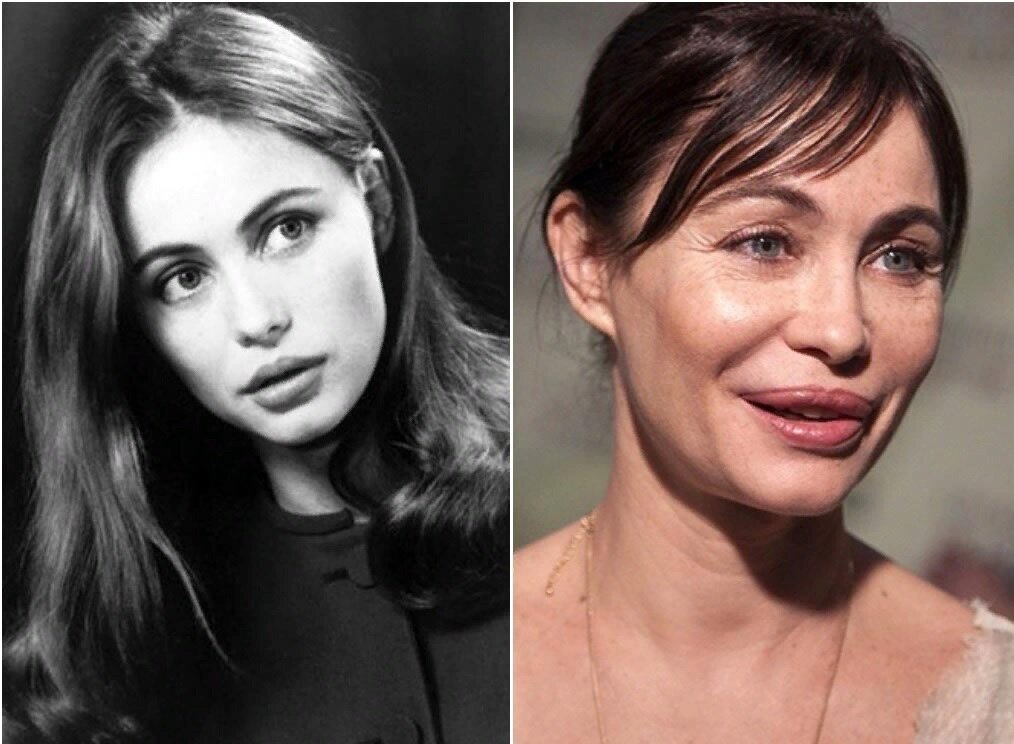 Эммануэль Беар до и после пластики