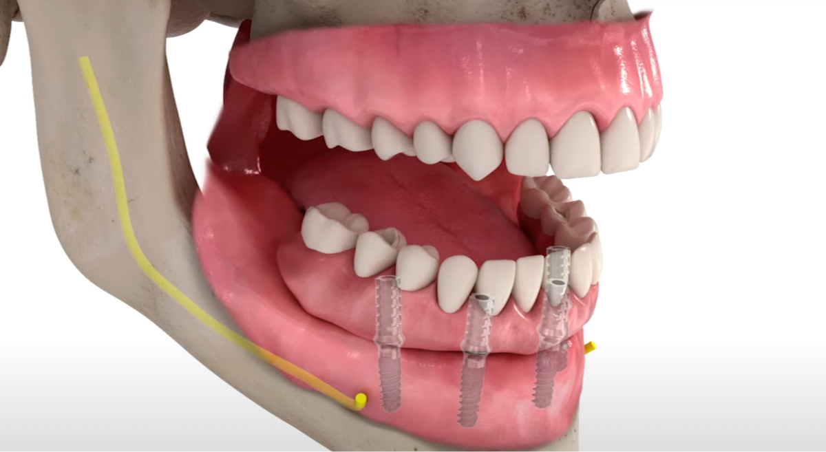 Имплантация все-на-4 с тотальным протезированием нижней челюсти