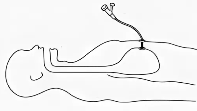 Гастростома пищевода. Гастростома свищ желудка. Эндоскопия желудка через гастростому. Питание через гастростому рисунок.