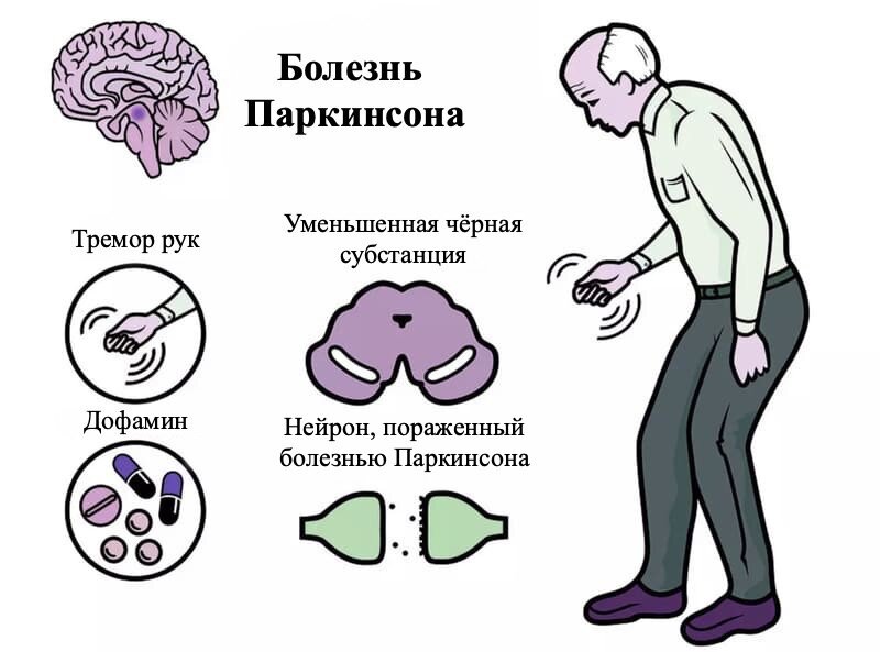 Болезнь паркинсона картинки