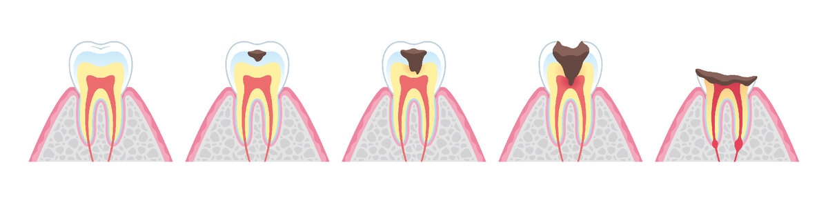 Постепенное разрушение зуба вследствие кариеса
