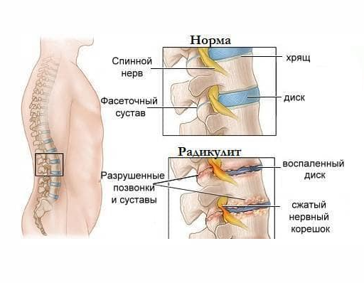 Цифровая книга "Лечение радикулита и ревматизма народными средствами" Попович На