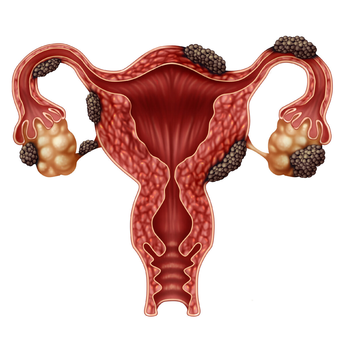Яичники у женщин расположение. Эндометриоз фаллопиевых труб. Эндометриоидная болезнь.