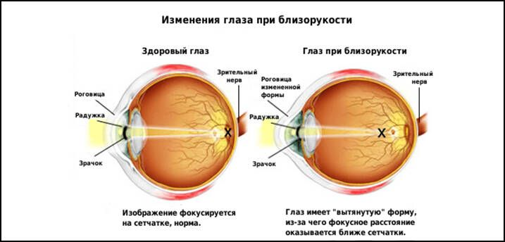 При близорукости изображение формируется перед сетчаткой