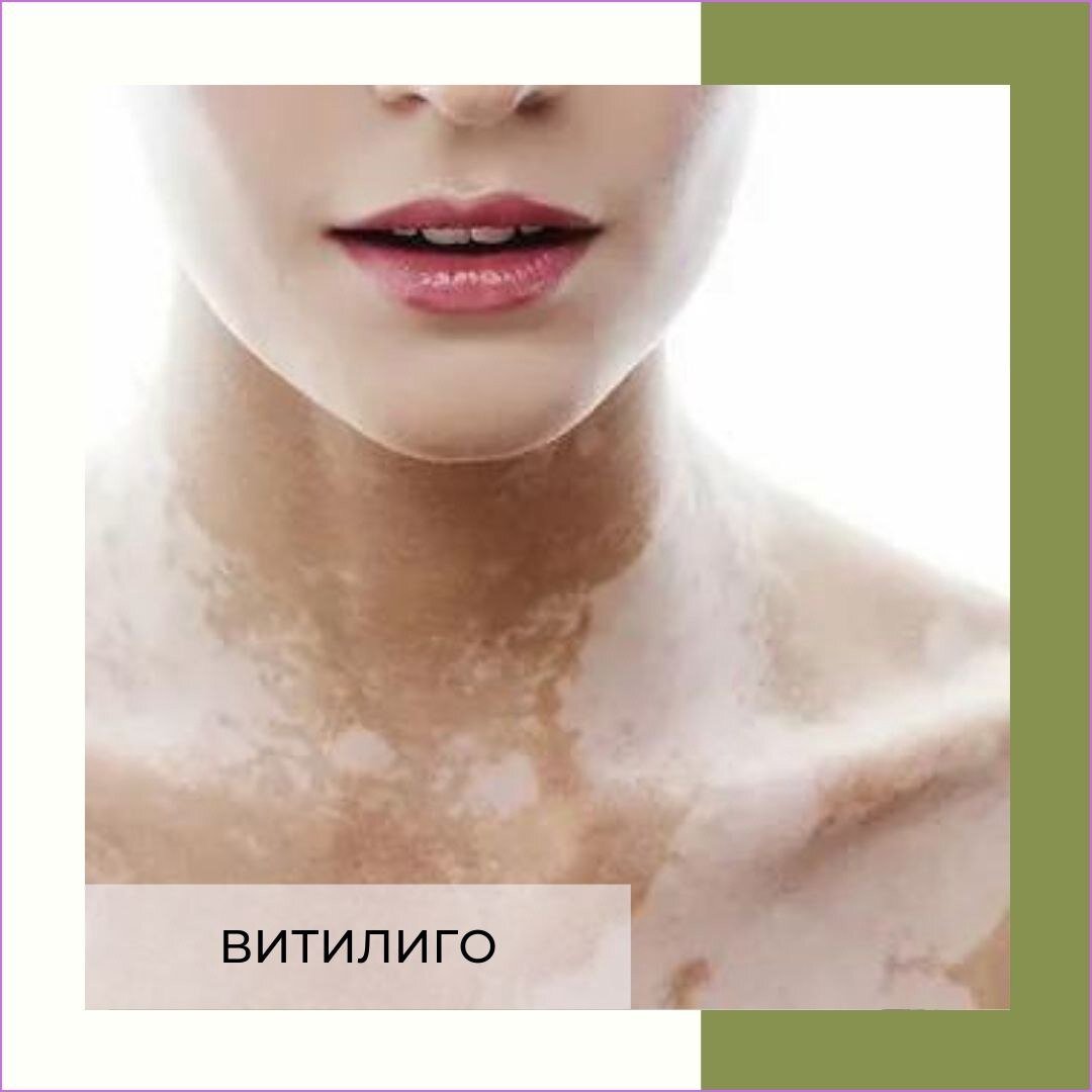ВИТИЛИГО