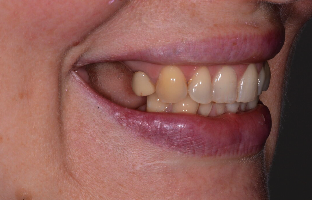 Обратит внимание на провалы из-за отсутствия зубов.