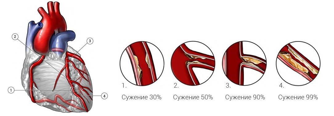 Субокклюзия показана на последней картинке.