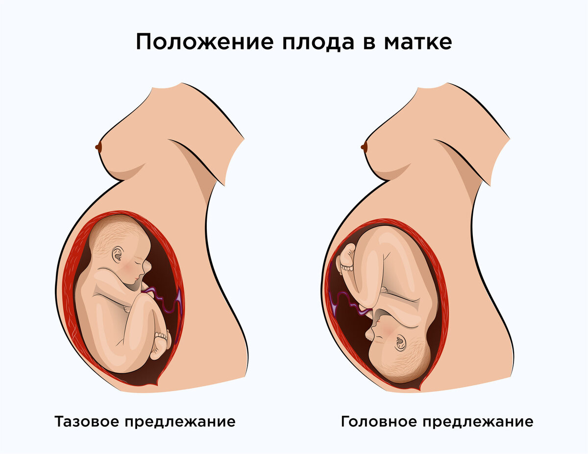 Тазовое предлежание