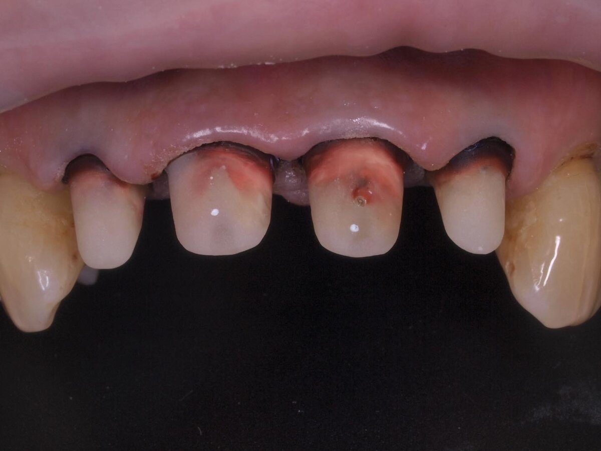 Зубы подготовлены для фиксации коронок