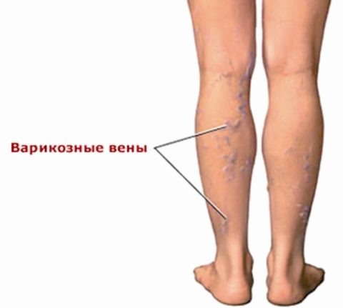 Начало развития заболевания