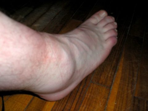  Снять отек после повреждения можно при помощи различных методов.