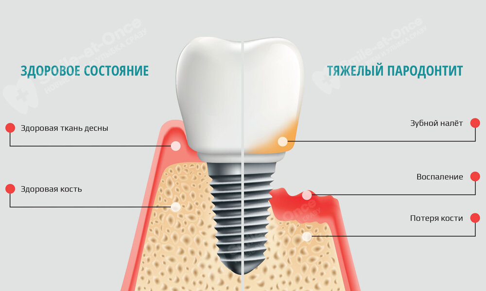 Имплант зубной больно. Воспаление десны вокруг имплантата. Отторжение зубного импланта. Симптомы отторжения имплантата.