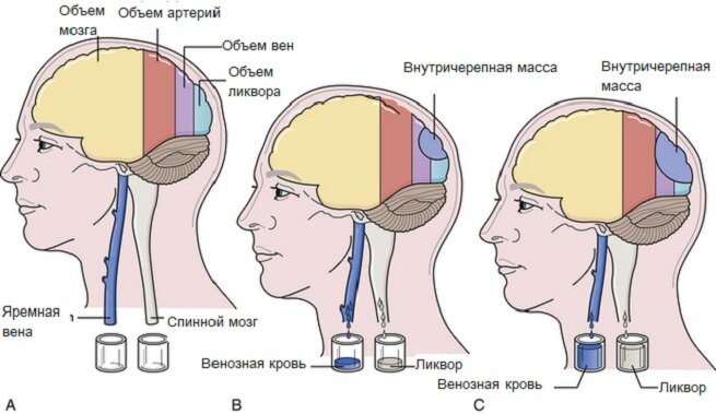 Внутричерепное давление – причины, симптомы, признаки, методы диагностики и лечение