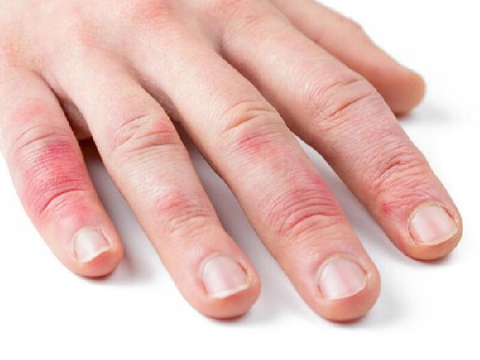 Фото Раздражения кожи рук.