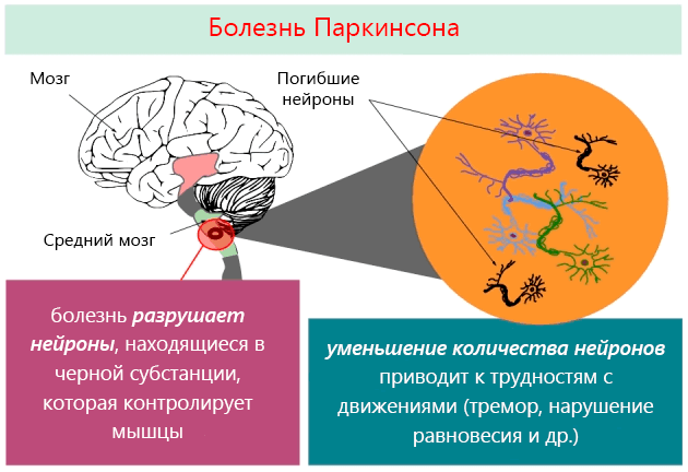 Что за болезнь паркинсона. Болезнь Паркинсона. Болезнь Паркинсона причины. Паркинсонизм поражение черной субстанции. Болезнь Паркинсона мозг.