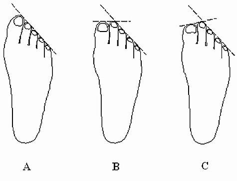 Лазерная эпиляция пальцев ног — Луи Дор салоны эпиляции