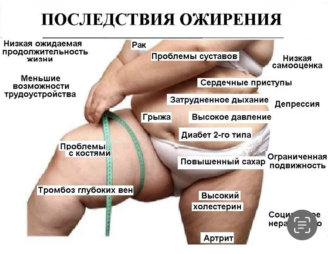 Может ли стать причиной. Ожирение 1 степени. Последствия ожирения для организма.