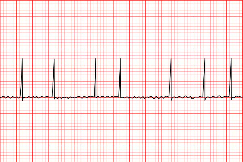 Криптогенный инсульт. Часть 3