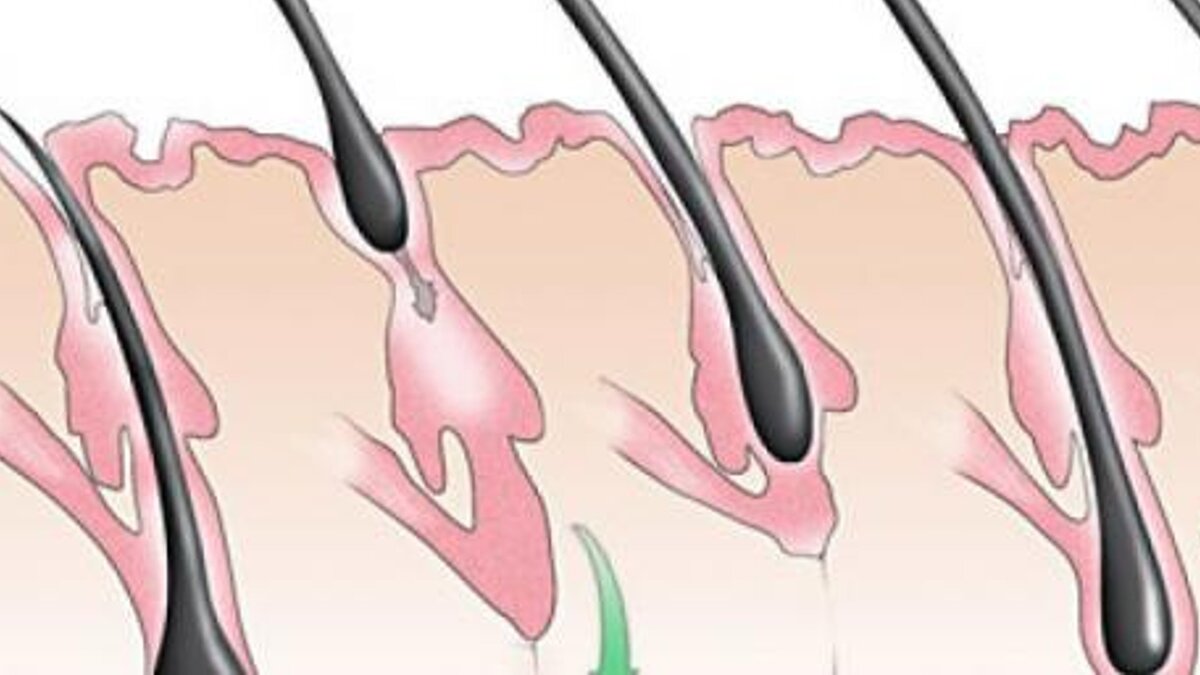 Как выглядит луковица волоса при выпадении фото