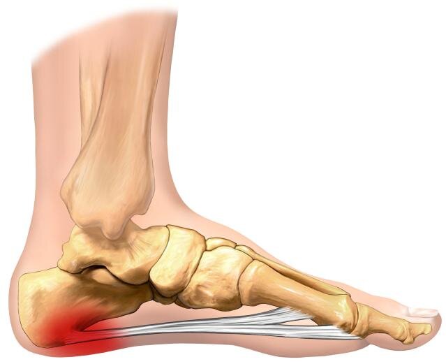 Больно наступать на пятку по утрам или в течение дня
